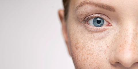 how to treat freckles