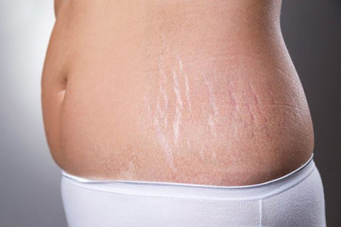 Causes of stretch marks after giving birth