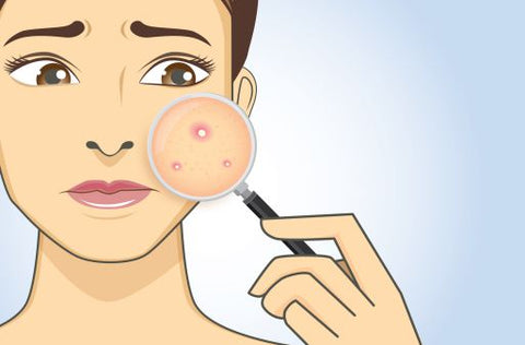 Oily acne skin needs to be supplemented with collagen to support skin recovery