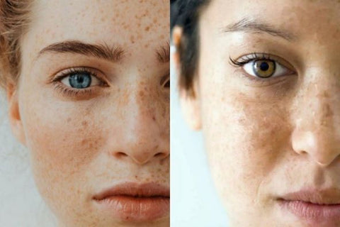 how to treat freckles