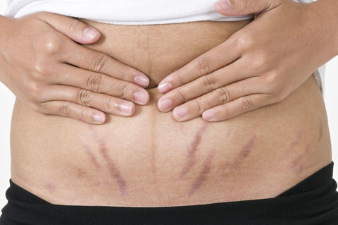 Stretch marks after giving birth