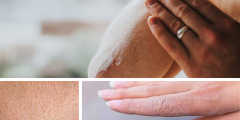 Dry Skin Issues from Winter Weather - cracked, dry and scaly skin