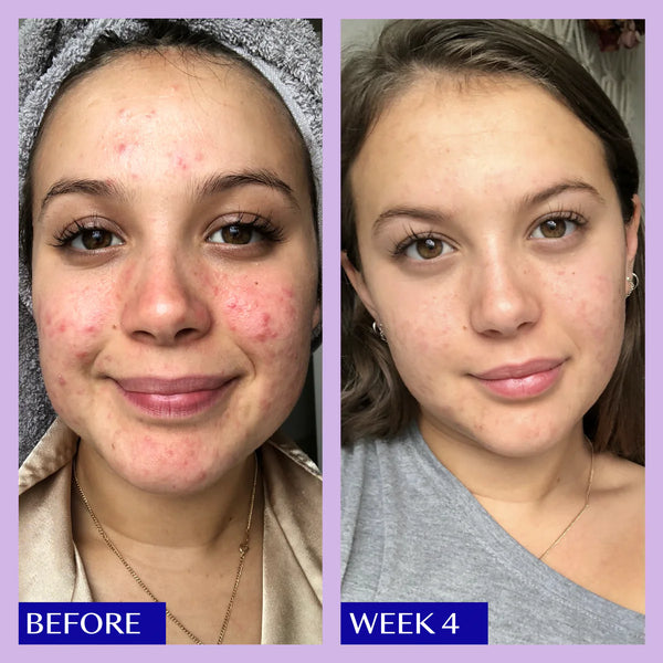 Before and after results for breakout prone skin