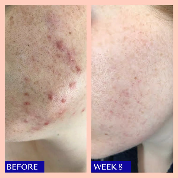 Real life results for breakout prone skin