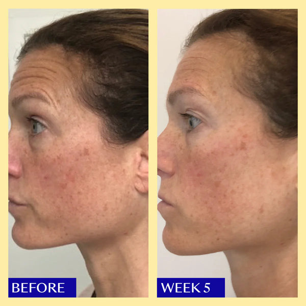 Results for hyperpigmention from Tailor Skincare