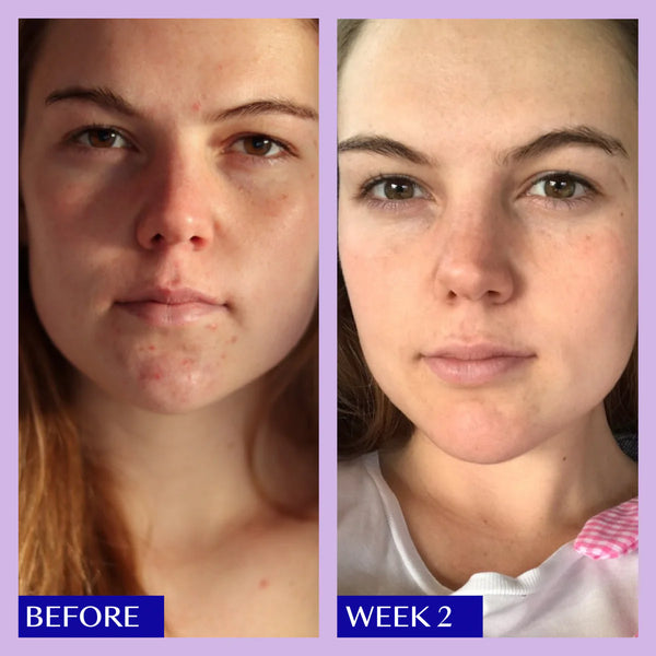 Real life tailored results for oily breakout prone skin