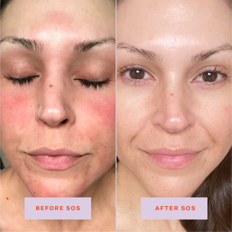 [Shared: Tower 28 Beauty SOS Daily Rescue Facial Spray Before + After Photo: left side of image (before) shows customer with redness on cheeks, forehead, and chin. Right side (after) of the image shows customer without redness on cheeks, forehead, and chin.]