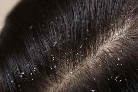 scalp health in the winter months combatting dandruff