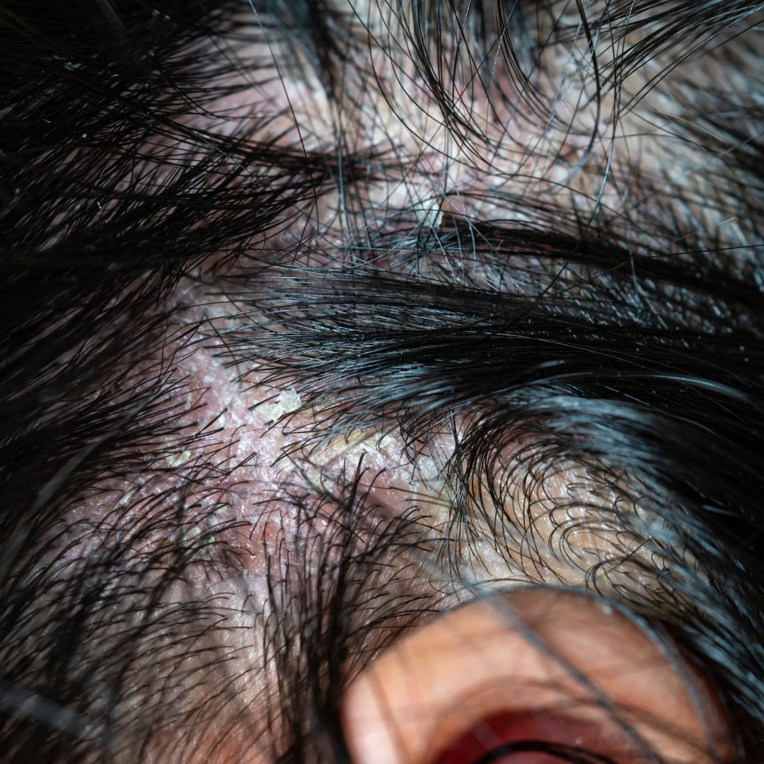 Things to Know and Do About Scalp Psoriasis – Forces of Nature Medicine
