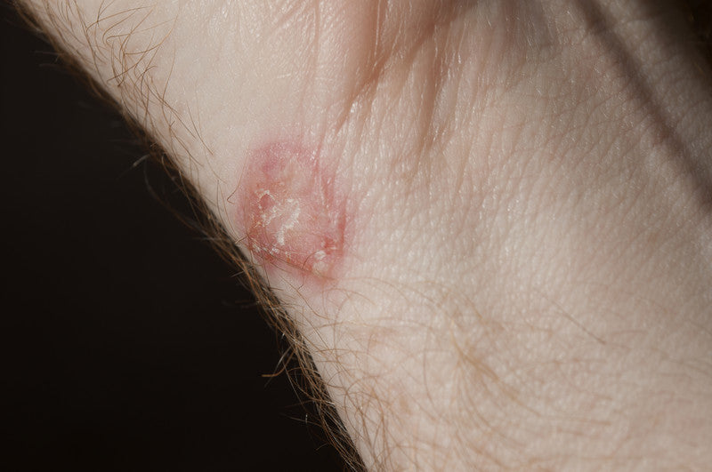 how-to-control-ringworm-from-being-contagious