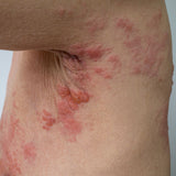 Person with shingles