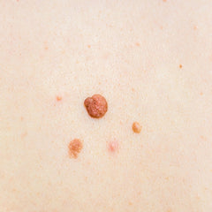 Is it a skin tag or mole?