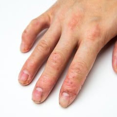 Hand Eczema