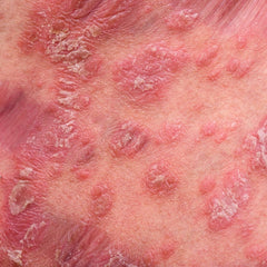 Psoriasis condition up close