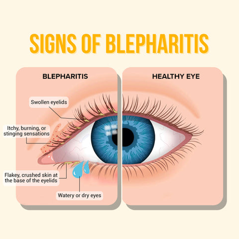 The image compares signs of Blepharitis with those of a healthy eye. In the 'BLEPHARITIS' section, the eye exhibits swollen eyelids, itching, burning, or stinging sensations, flaky skin at the base of the eyelids, and watery eyes. In contrast, the 'HEALTHY EYE' section shows a normal eye without any issues.