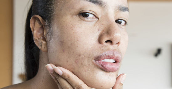 Tips for Adult Acne Prevention