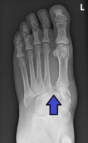 lisfranc fractures