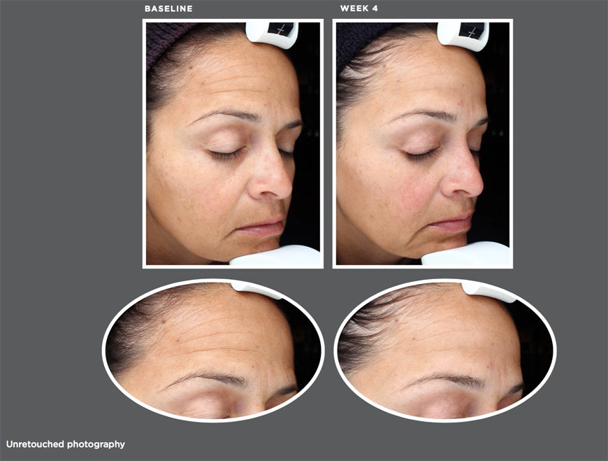 sente dermal repair for hyperpigmentation