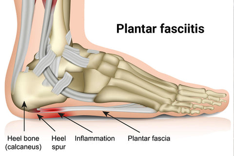 NuuSol-Skeletal foot showing plantar fasciitis pain