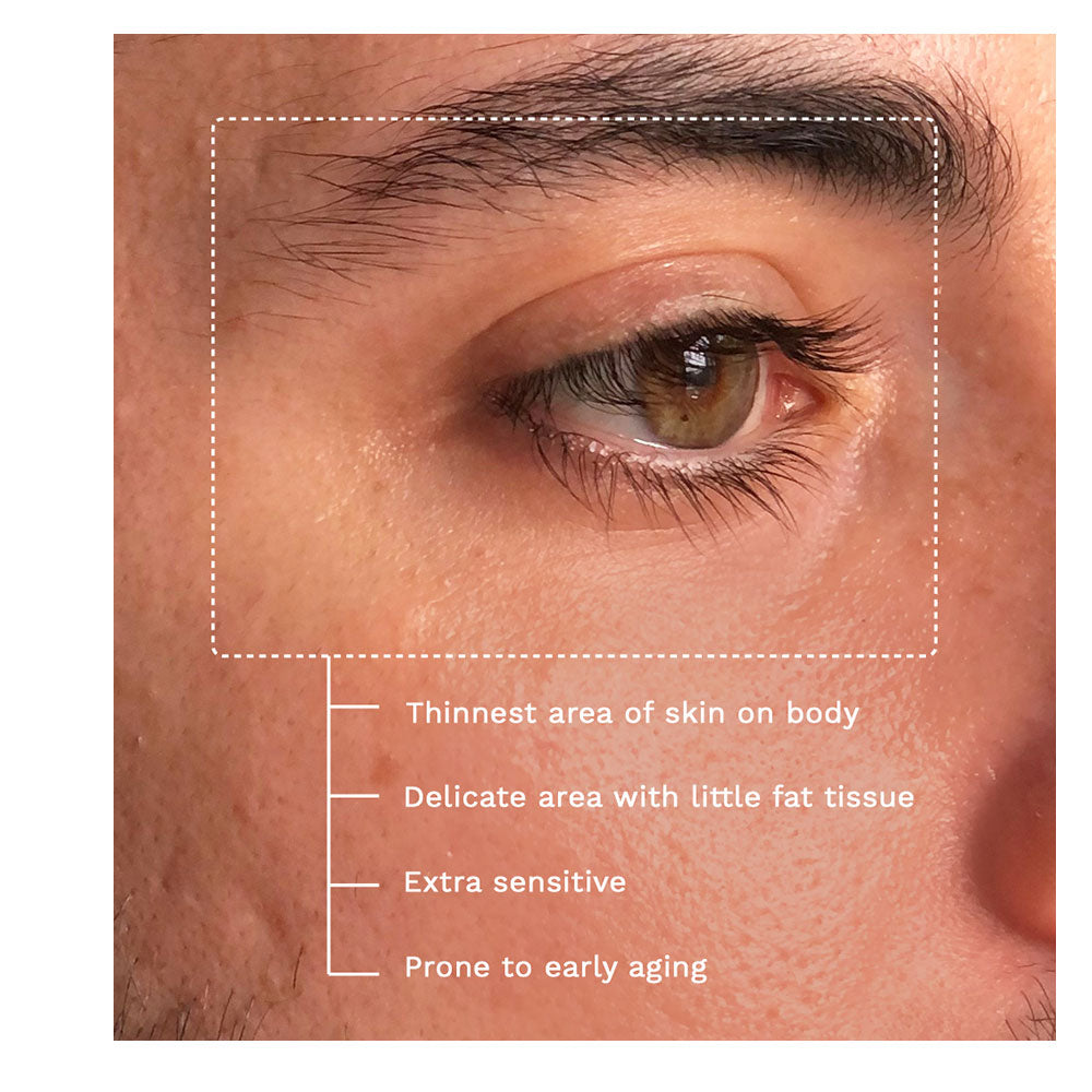 Why do we get dark circles?