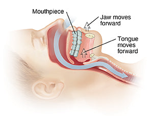 Do mouth guards help with sleep apnea?