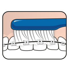 TeePe Implant Ortho para brackets