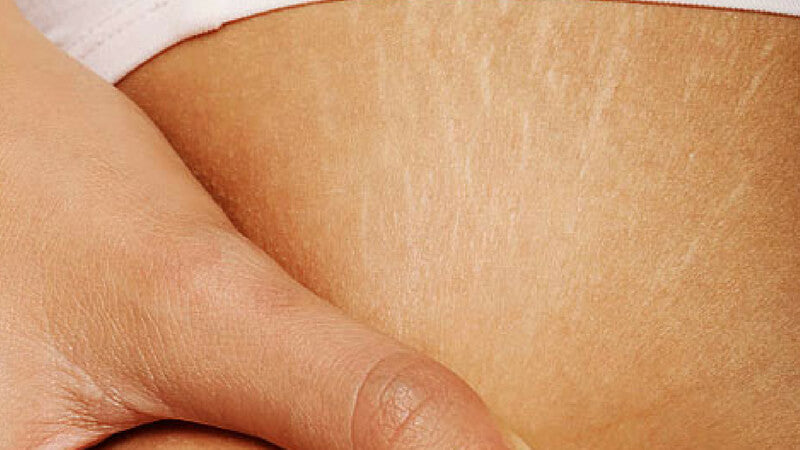 Collagen helps reduce stretch mark