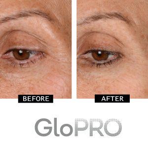 CurrentBody | GloPRO: Before & After