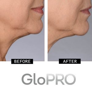 CurrentBody | GloPRO Before & After