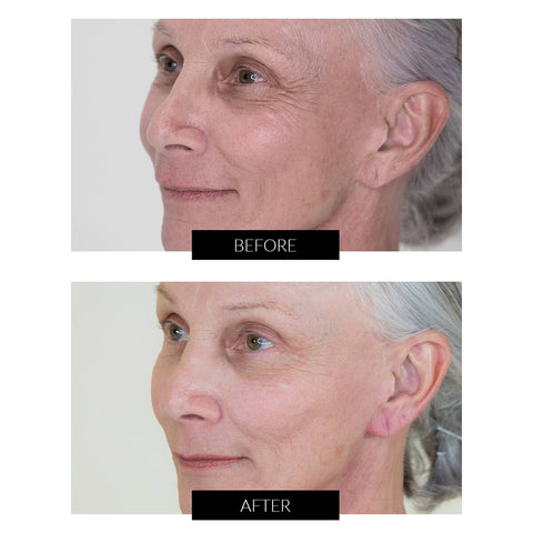 Før og efter billeder fra behandling med NIRA Pro Skincare Laser
