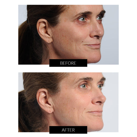 Før og efter billeder fra behandling med NIRA Pro Skincare Laser