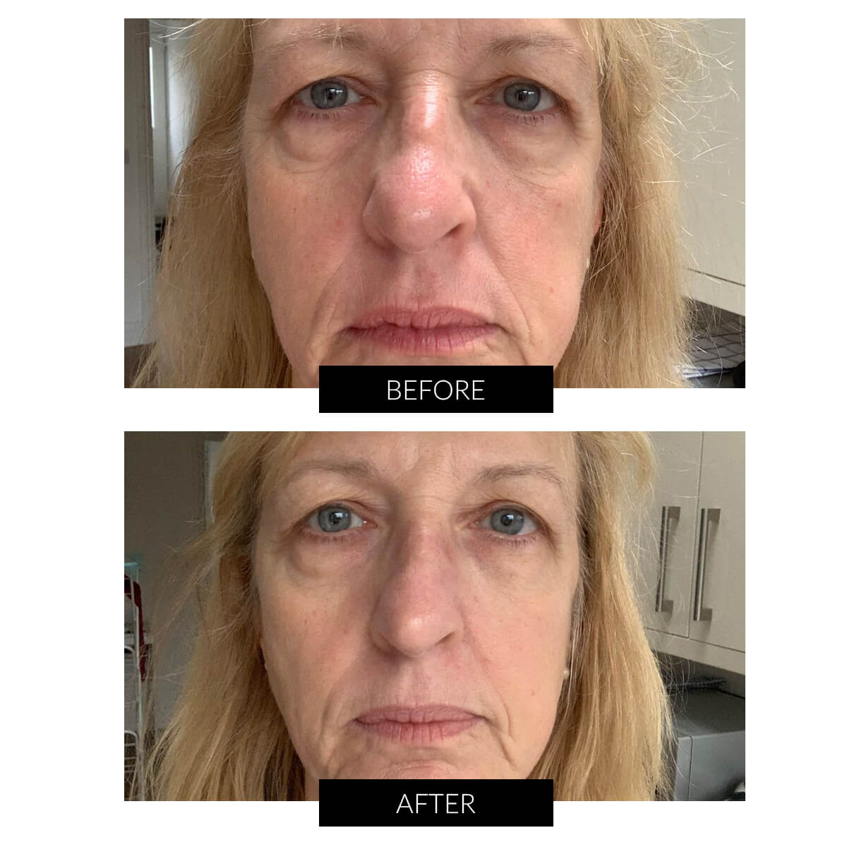 Før og efter billeder ved brug af lysterapi masken