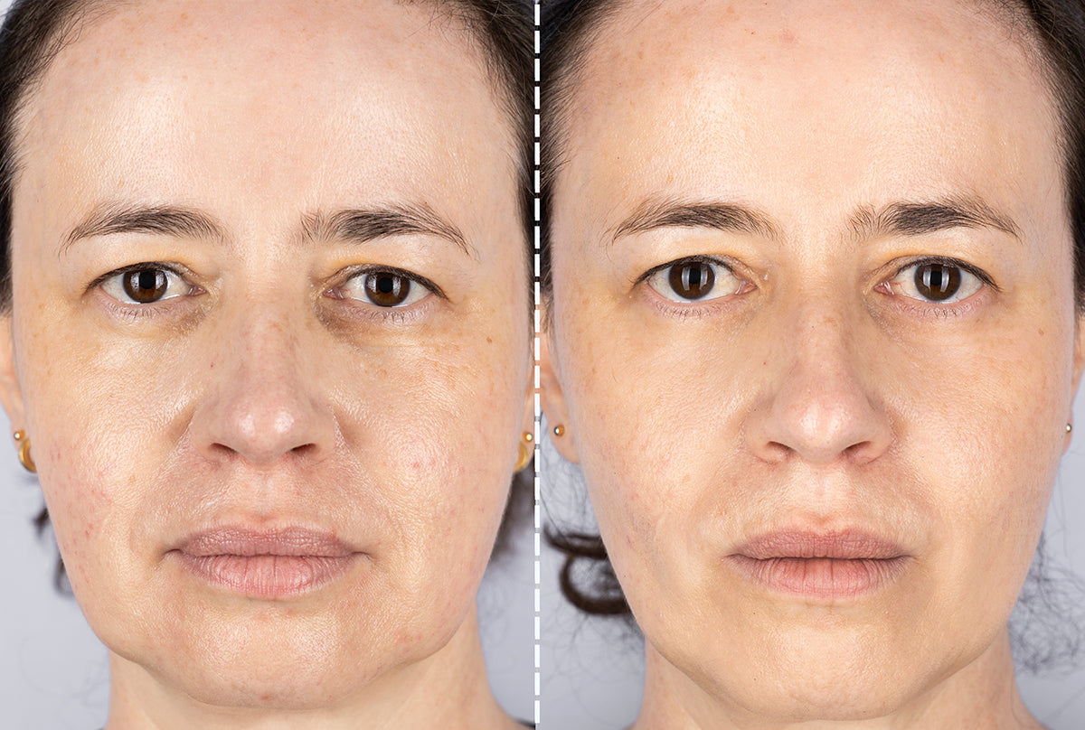 Led light therapy before and after