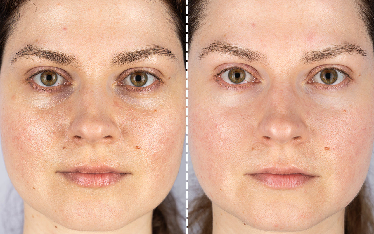 led light therapy before and after