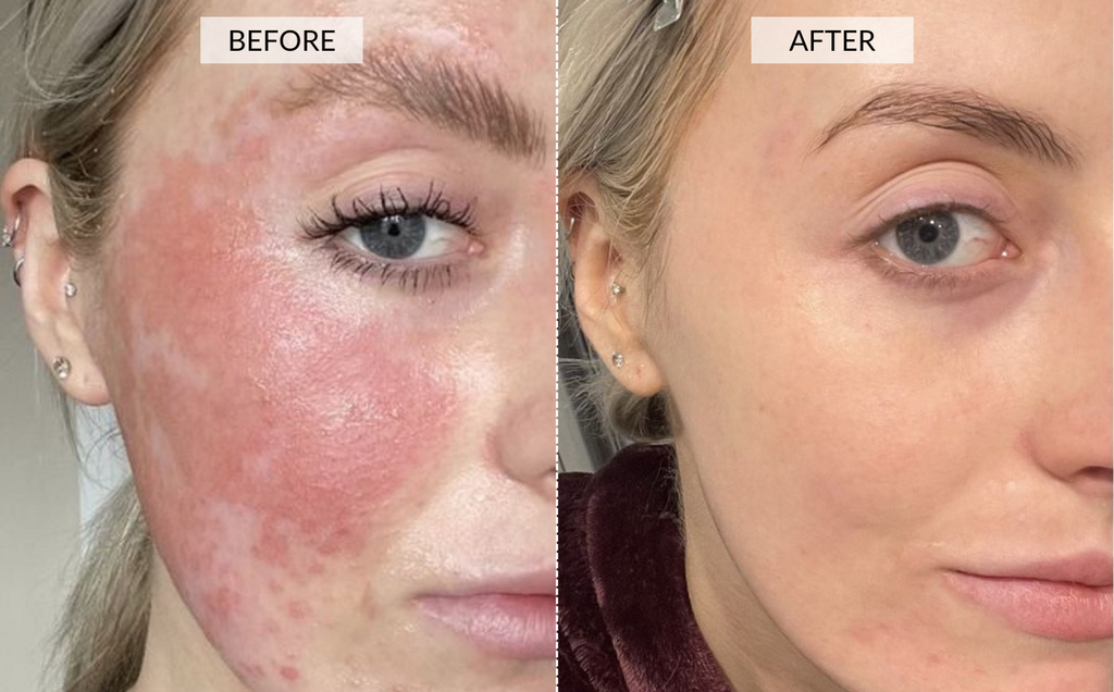 rosacea before and after