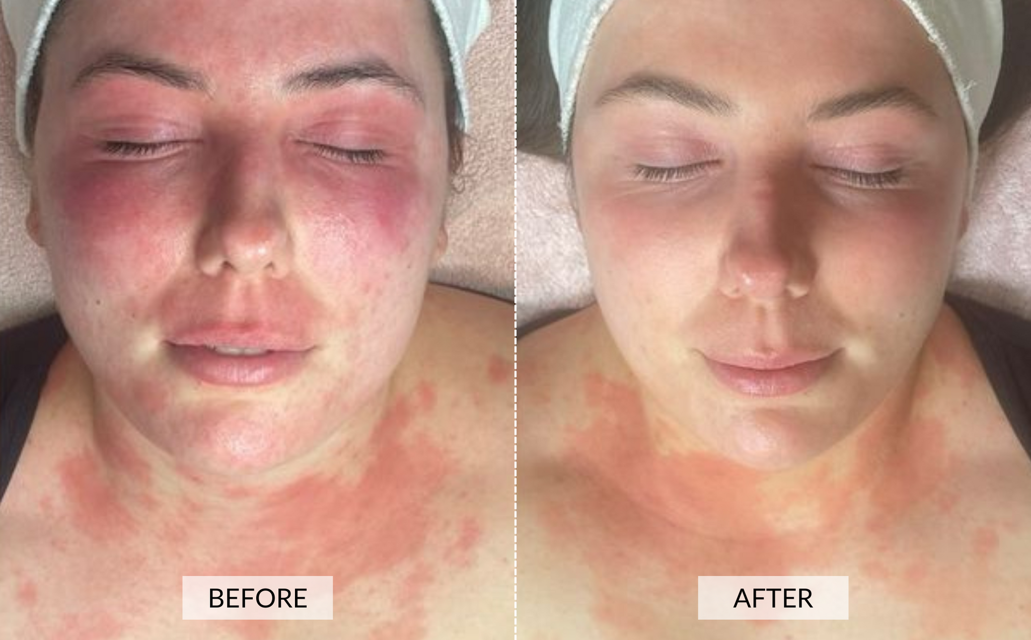 red light therapy eczema before and after