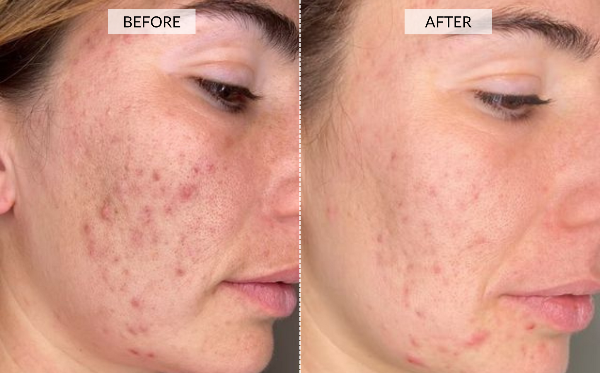 Dermalux before and afters