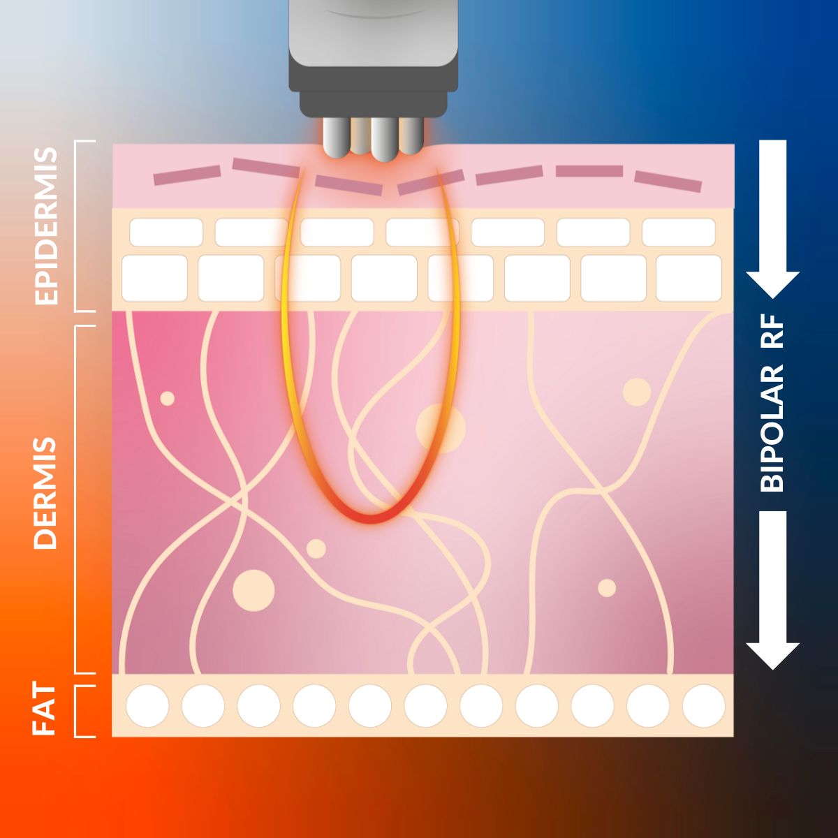 RF skin tightening