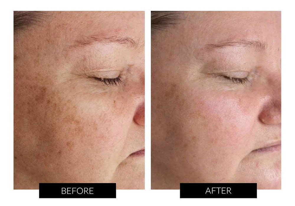 What is rosacea and how can LED light therapy help? CurrentBody