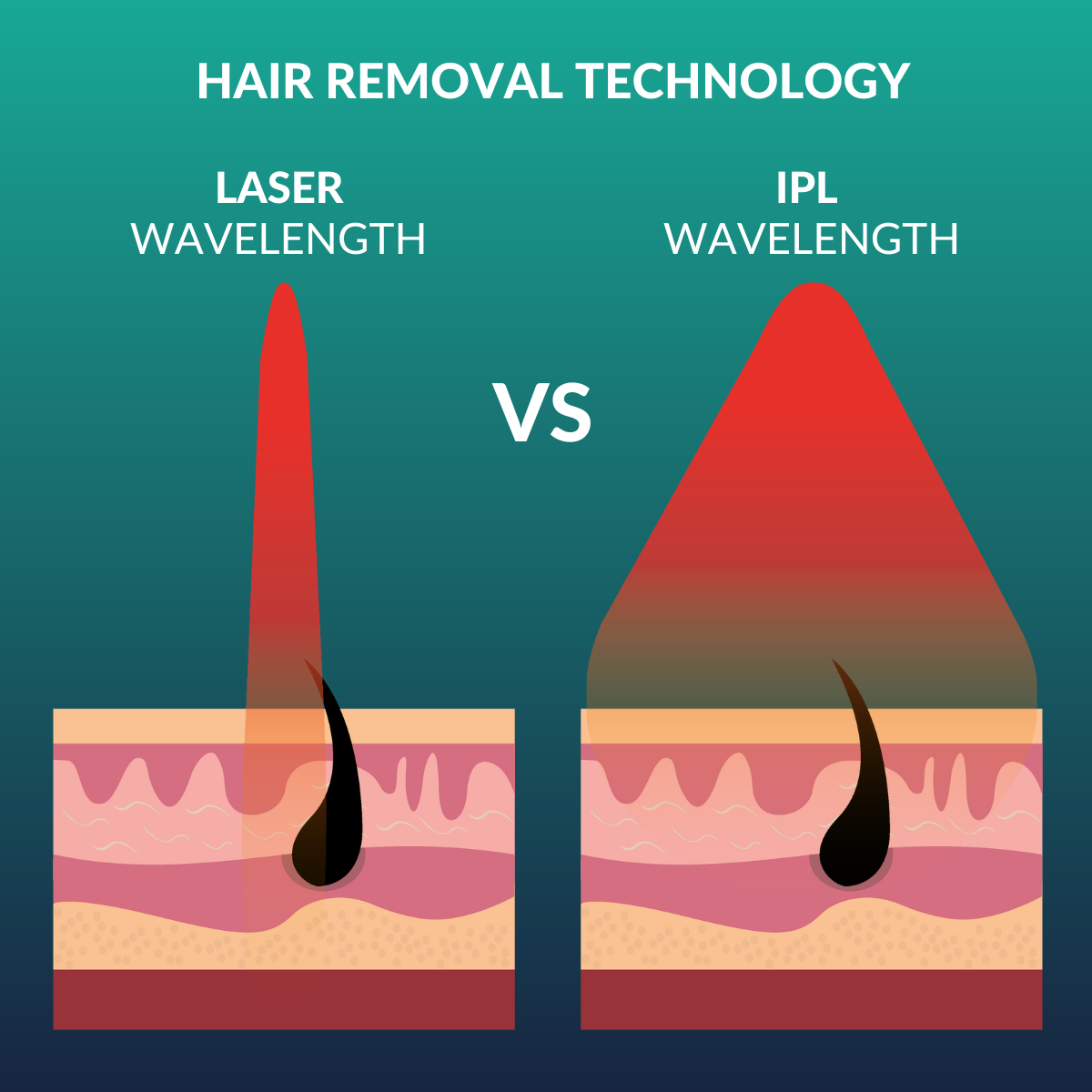 IPL vs Laser hair removal