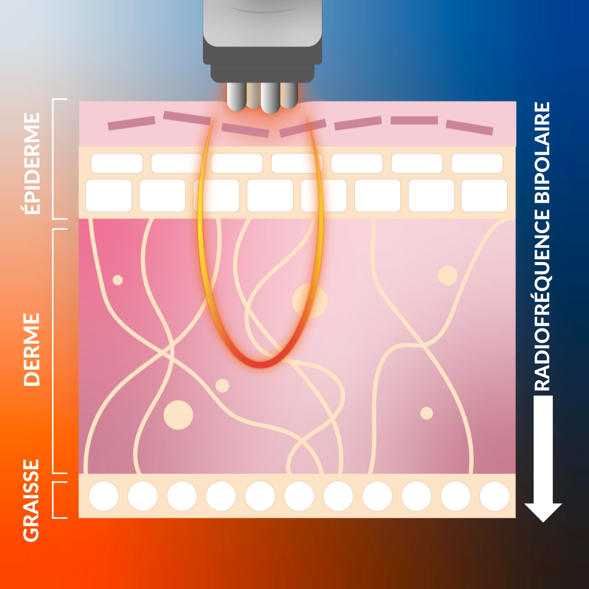 radio frequency skin tightening