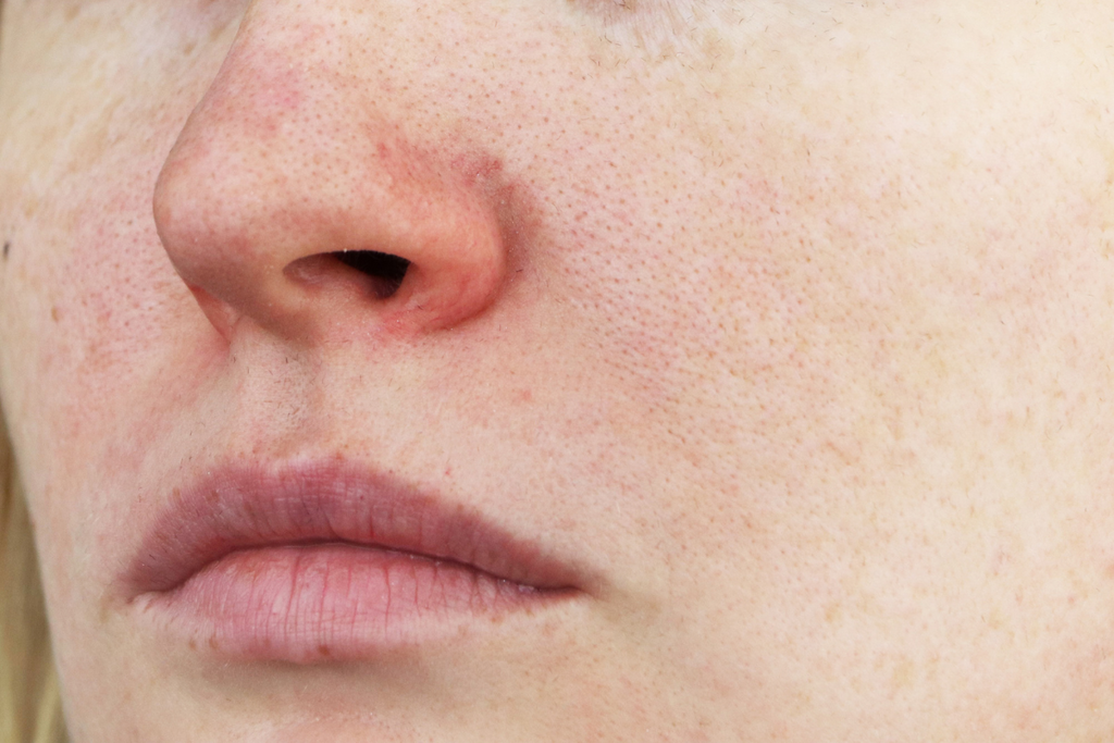 rosacea