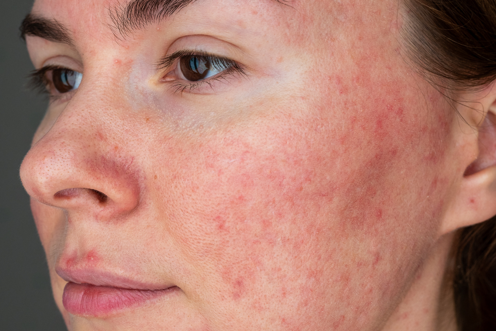 rosacea