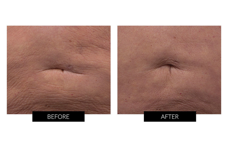 Før og efter billede efter behandling med NuBODY Skin