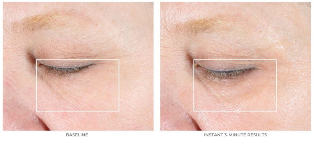 Introducing the NuFACE FIX