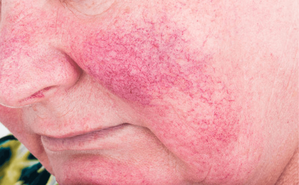 Tæt på rosacea