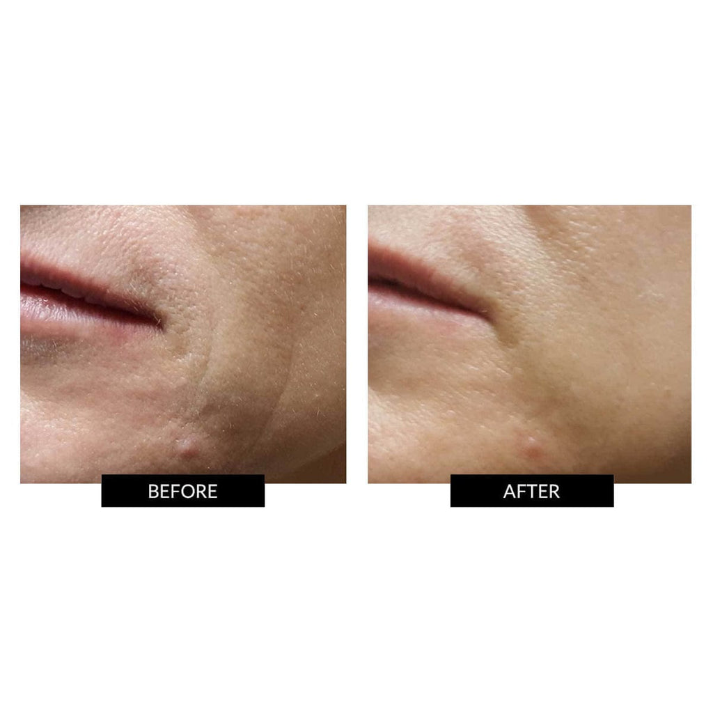 Før og efter billeder ved behandling med ZIIP Beauty Nano Current Skincare Device