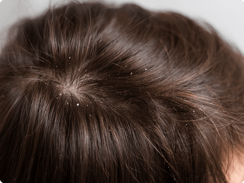 The Importance of Scalp Health in Hair Growth